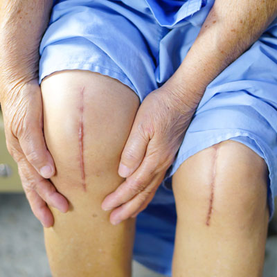 knee replacement surgery in AP